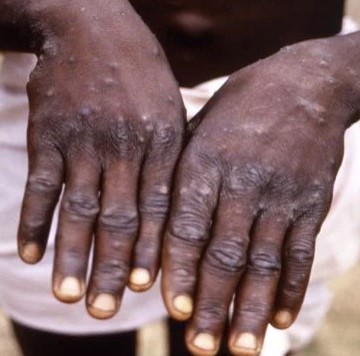 Attacks on Monkeys Increasing Over Fears of Spread of Monkeypox in Brazil