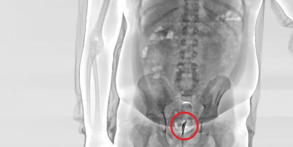 Over 10,000 Attempts to Smuggle Contraband Thwarted by X-Ray Body Scanners