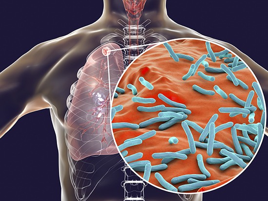 Tuberculosis Cases in England Continued to Increase in 2024